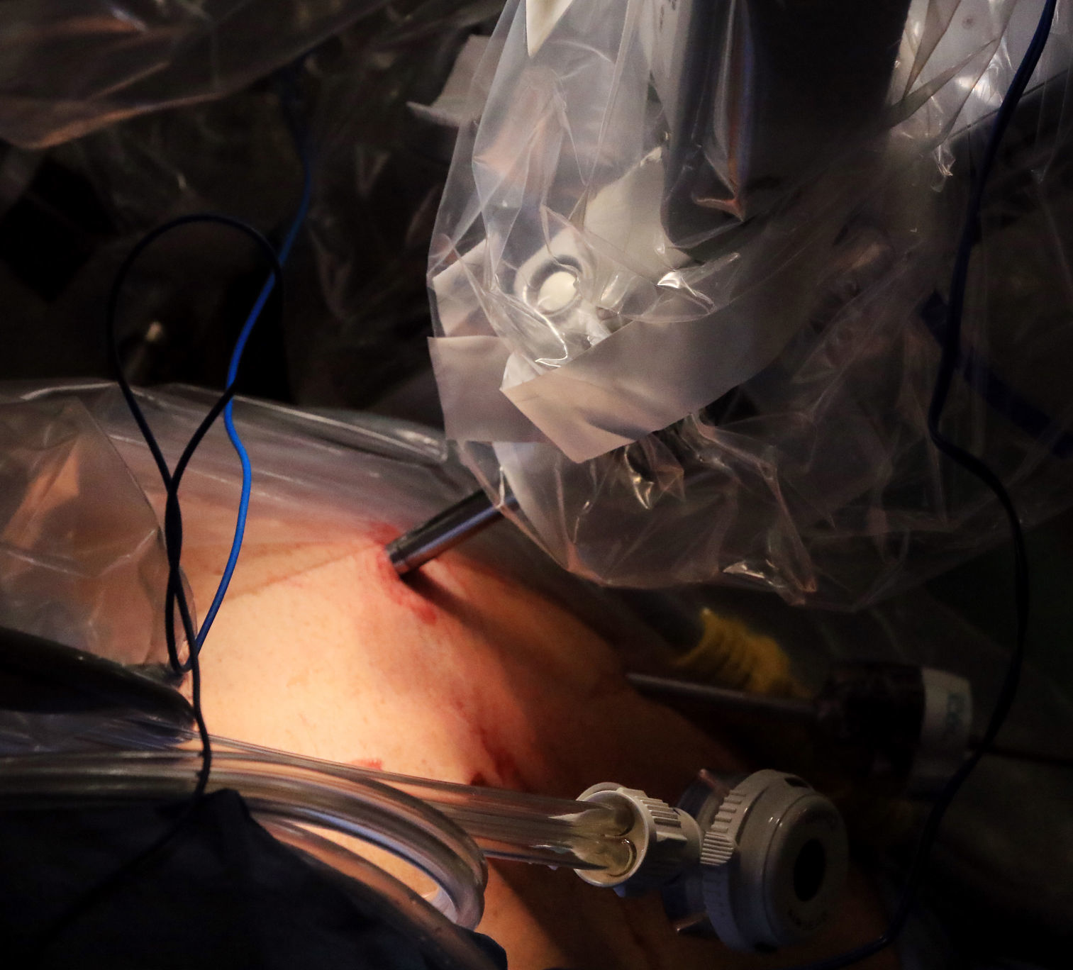 Robotic surgery